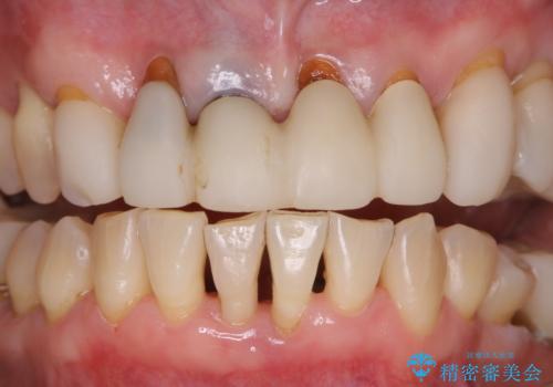 ワインによる着色をPMTCでキレイにの治療後