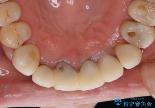 ワインによる着色をPMTCでキレイにの治療後