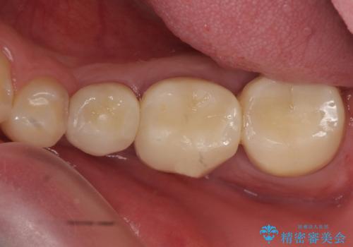 オールセラミッククラウン 歯の挺出・歯周外科による歯茎より深い虫歯の治療の治療後