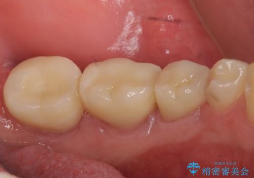 オールセラミッククラウン 歯の挺出・歯周外科による歯茎より深い虫歯の治療の治療後