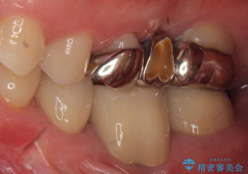 オールセラミッククラウン 歯の挺出・歯周外科による歯茎より深い虫歯の治療の治療後