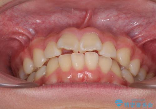 前歯のデコボコを短期間で治療 目立たないワイヤー矯正の治療前