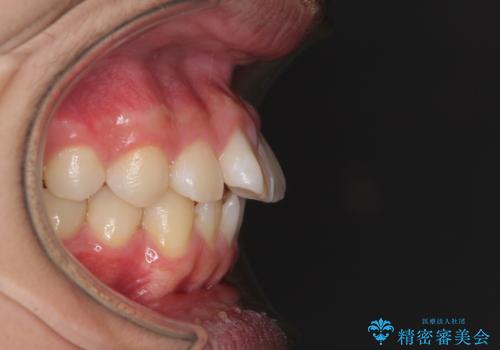 前歯のデコボコを短期間で治療 目立たないワイヤー矯正の治療前