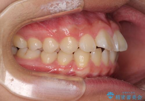 前歯のデコボコを短期間で治療 目立たないワイヤー矯正の治療前