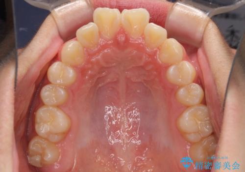 前歯のデコボコを短期間で治療 目立たないワイヤー矯正の治療前