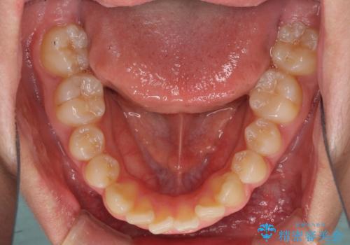 前歯のデコボコを短期間で治療　目立たないワイヤー矯正の治療前