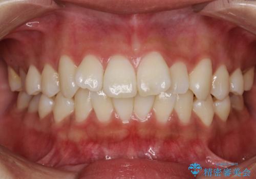 がたがたをインビザラインで整った歯並びへの症例 治療前