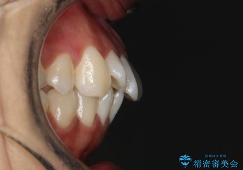がたがたをインビザラインで整った歯並びへの治療前