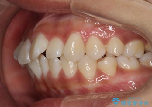 がたがたをインビザラインで整った歯並びへの治療前