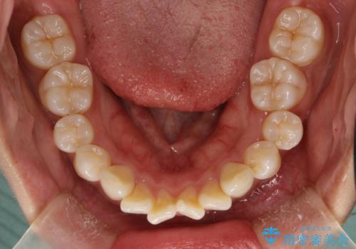 がたがたをインビザラインで整った歯並びへの治療前