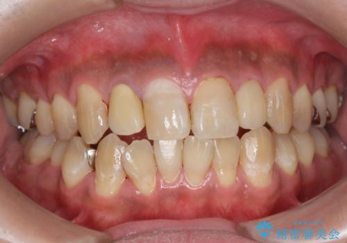 PMTC(歯科医院での専門的クリーニング)でステインを除去し白くきれいな歯に!の治療後