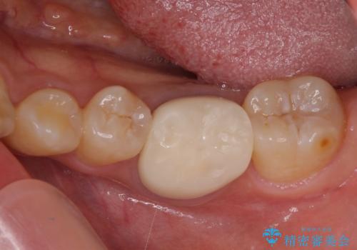 形が気に入らない 奥歯のオールセラミッククラウンの症例 治療前