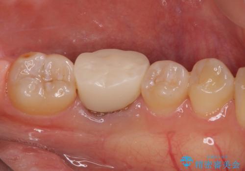 形が気に入らない 奥歯のオールセラミッククラウンの治療前