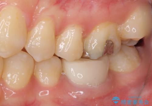 形が気に入らない 奥歯のオールセラミッククラウンの治療前