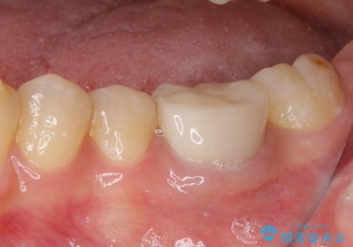 形が気に入らない 奥歯のオールセラミッククラウンの治療前