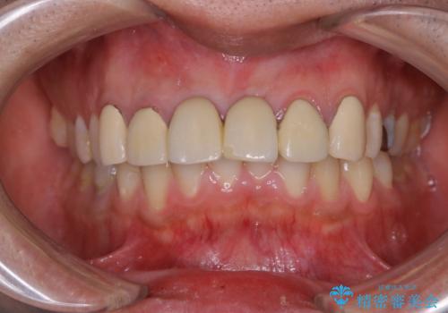 1年ぶりのPMTCの治療前