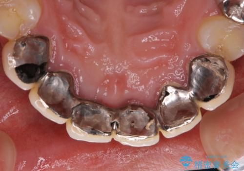 1年ぶりのPMTCの治療前