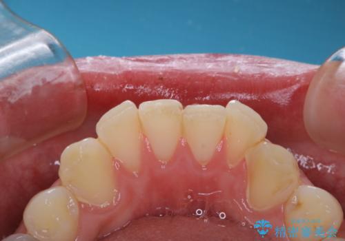 1年ぶりのPMTCの治療前