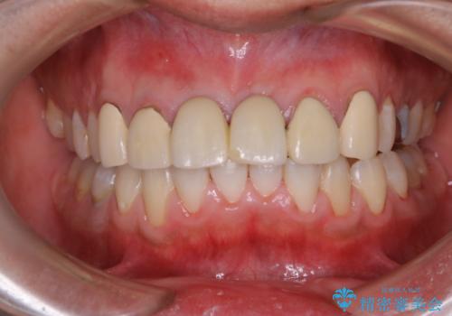 1年ぶりのPMTCの治療後