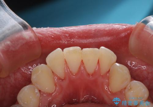 1年ぶりのPMTCの治療後