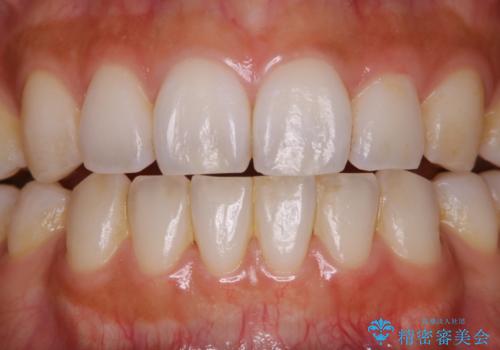 PMTCでスムーズにデンタルフロスが通るようにの治療前