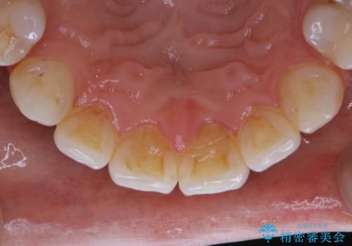 PMTCでスムーズにデンタルフロスが通るようにの治療前