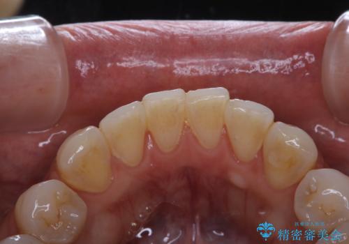 PMTCでスムーズにデンタルフロスが通るようにの治療前