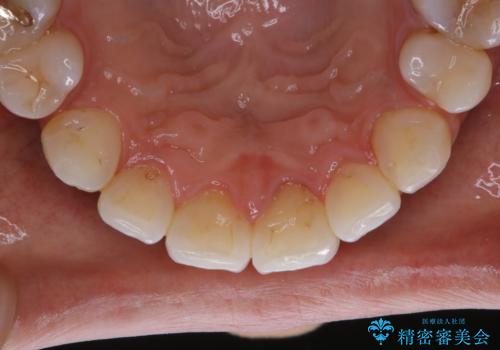 PMTCでスムーズにデンタルフロスが通るようにの治療後