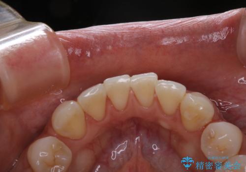 PMTCでスムーズにデンタルフロスが通るようにの治療後