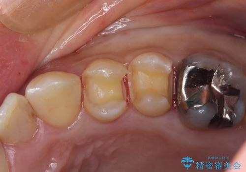 見える金属を白くしたい、セラミック治療の治療中
