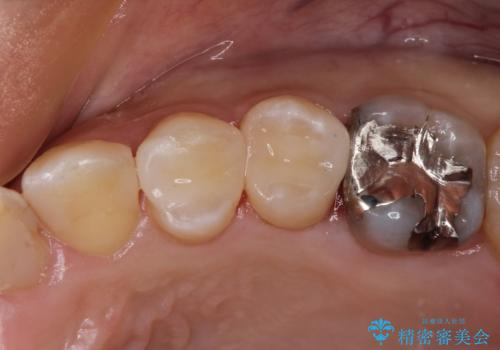 見える金属を白くしたい、セラミック治療の症例 治療後
