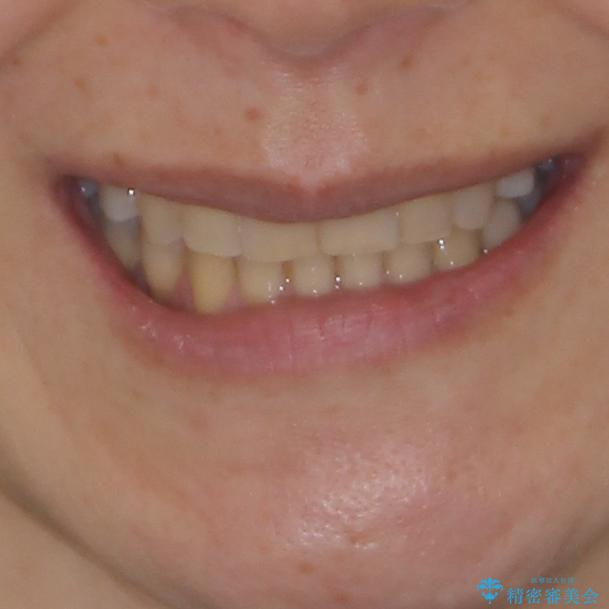 矯正の後戻りの改善と銀歯をセラミックにの治療後（顔貌）