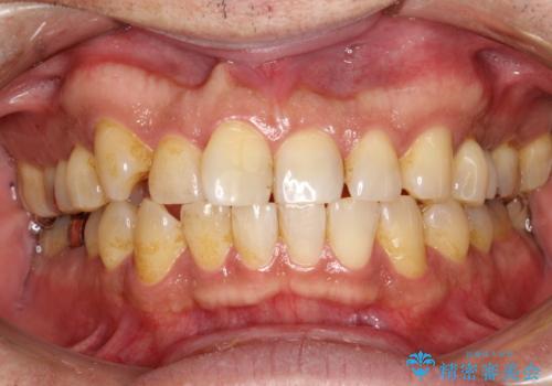 久しぶりのPMTCで歯を綺麗にの治療前