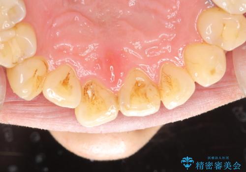 久しぶりのPMTCで歯を綺麗にの治療前