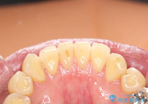 久しぶりのPMTCで歯を綺麗にの治療前