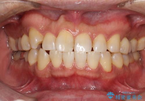 久しぶりのPMTCで歯を綺麗にの治療後
