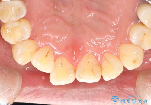 久しぶりのPMTCで歯を綺麗にの治療後