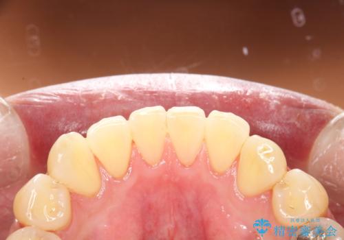 久しぶりのPMTCで歯を綺麗にの治療後