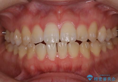 アタッチメント周囲のステインOFFをPMTC での治療前