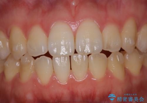 アタッチメント周囲のステインOFFをPMTC での治療前