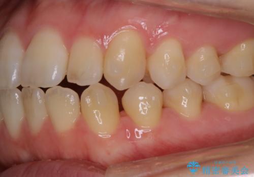 アタッチメント周囲のステインOFFをPMTC での治療前