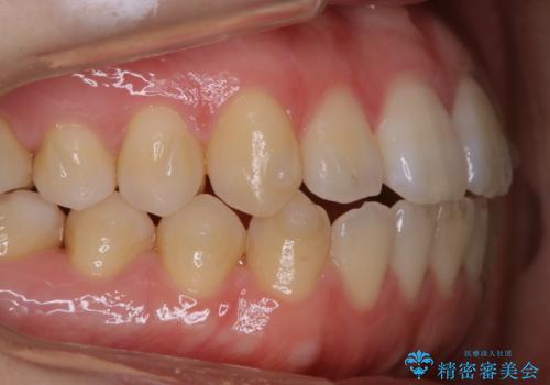 アタッチメント周囲のステインOFFをPMTC で