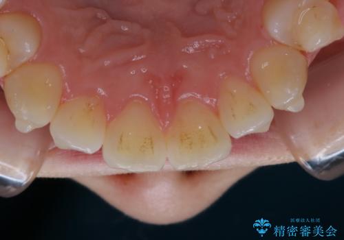 アタッチメント周囲のステインOFFをPMTC での治療前