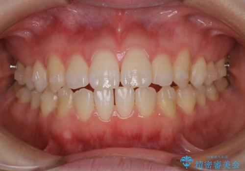 アタッチメント周囲のステインOFFをPMTC での治療後