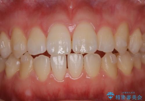 アタッチメント周囲のステインOFFをPMTC での治療後