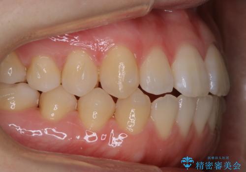 アタッチメント周囲のステインOFFをPMTC での症例 治療後