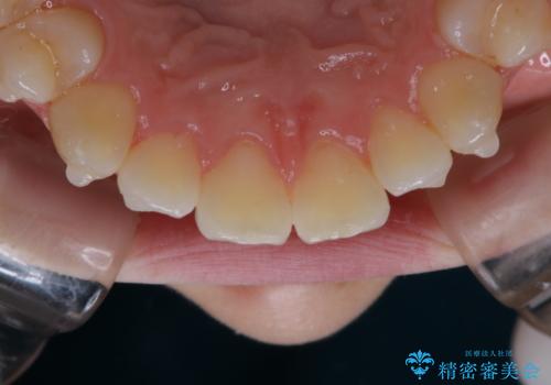 アタッチメント周囲のステインOFFをPMTC での治療後