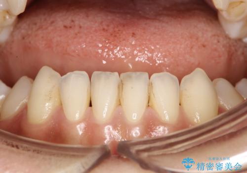 前歯の着色をPMTCできれいに除去の治療前