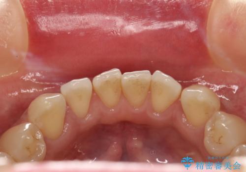 前歯の着色をPMTCできれいに除去の治療前