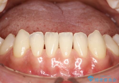 前歯の着色をPMTCできれいに除去の治療後